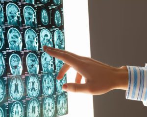 BrainInjuries