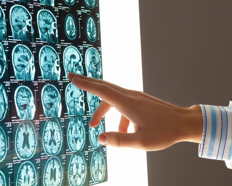BrainInjuries