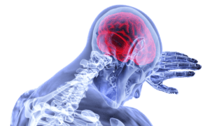 brain xray