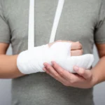 Man with broken arm in cast